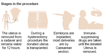 uterus-transplant